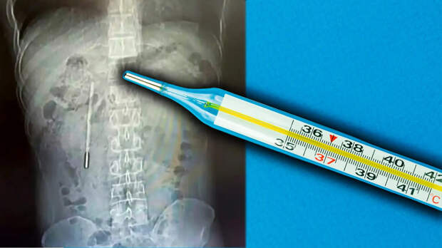 Житель Вэньчжоу 20 лет жил с проглоченным в детстве ртутным градусником