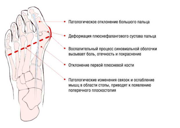 Косточки на ногах: избавляемся просто и без боли. И операции не нужно!