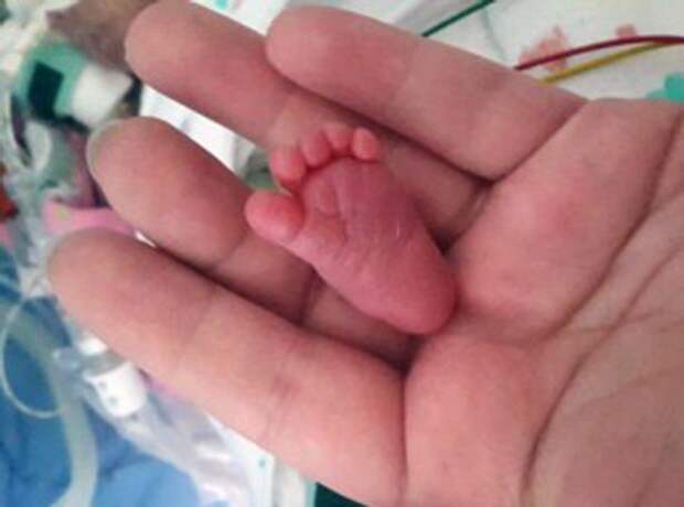 Emilia's baby foot measured 3.1 centimetres in the birth