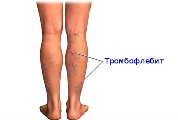 Тромбофлебит: Симптомы и лечение