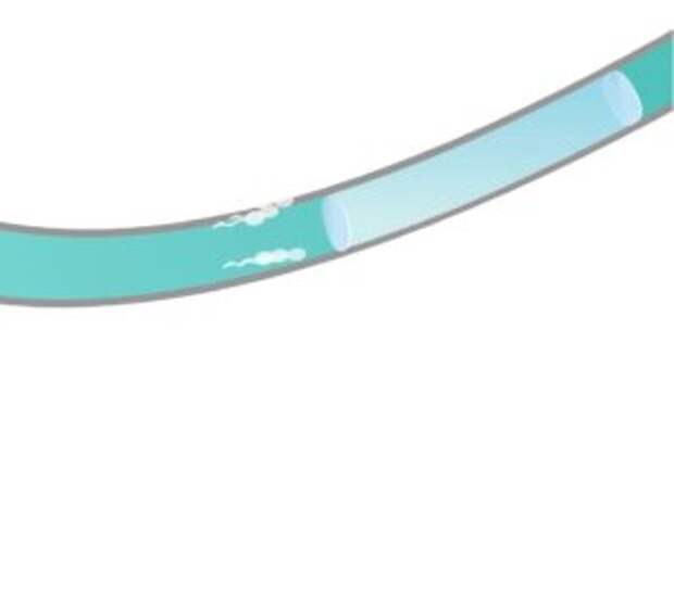vas deferens sperm blocker contraceptive Contraline