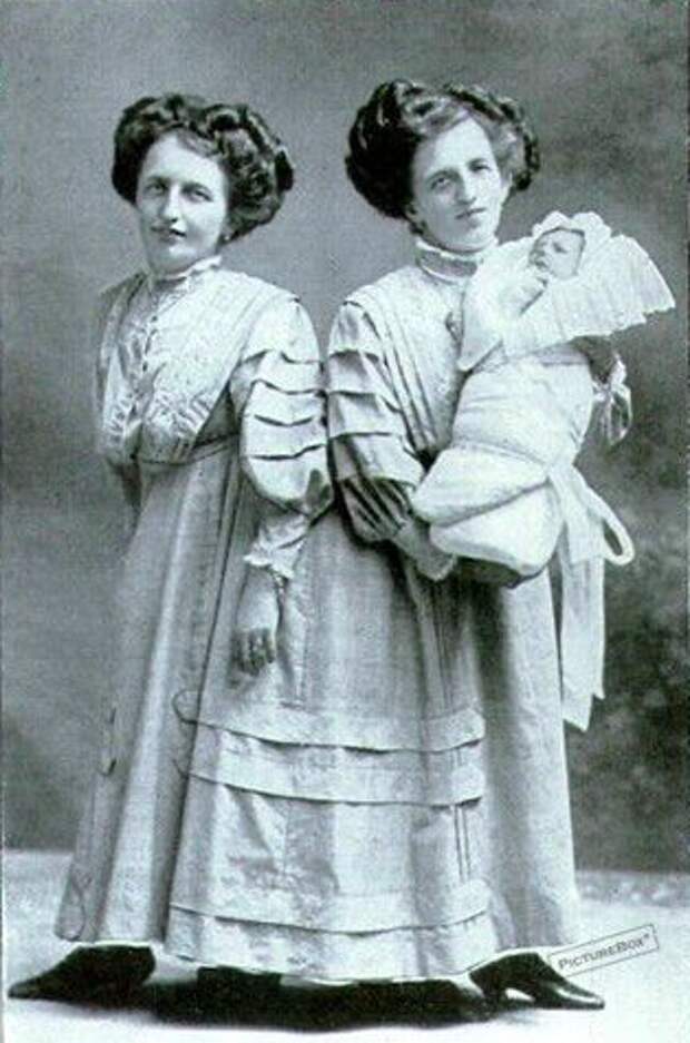 9. Близнецы Жозефа и Роза Блазе с сыном Розы, 1910 год интересно, история, люди-мутанты, мутации, прошлое, фото