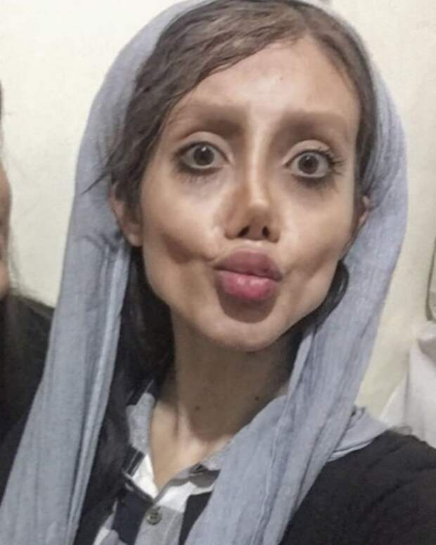 50 операций ради сходства с Анджелиной Джоли изуродовали иранку