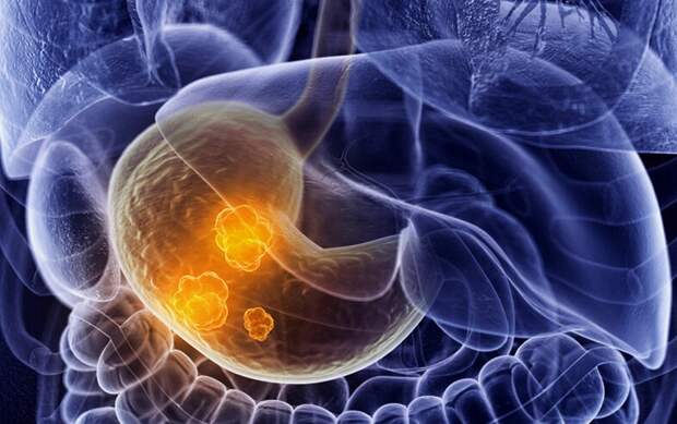 Повышает риск рака желудка на 41% ученые назвали коварную приправу