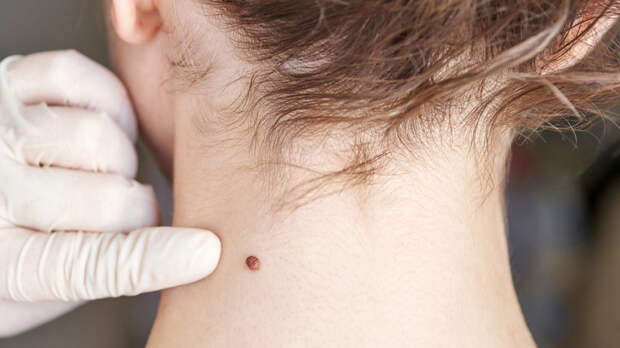 Онколог посоветовал обратиться к врачу при резком увеличении размера родинки