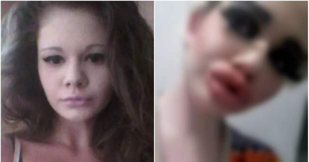 Фото Студентка Иванова в 4 раза увеличила себе губы, чтобы стать "Барби"