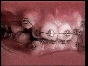 Teeth Braces GIF